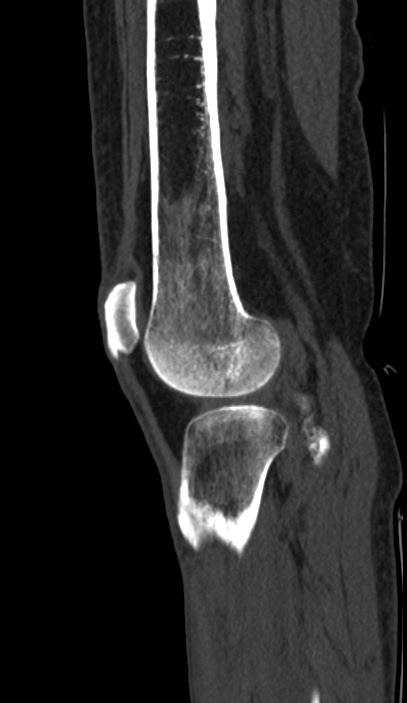 Calcified hematoma - popliteal fossa (Radiopaedia 63938-72763 Sagittal bone window 92).jpg