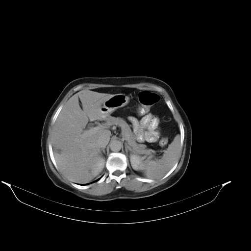 File:Calcified hydatid cyst of the liver (Radiopaedia 21212-21112 Axial C+ delayed 16).jpg