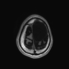 Callosal dysgenesis with interhemispheric cyst (Radiopaedia 53355-59335 Axial T1 142).jpg