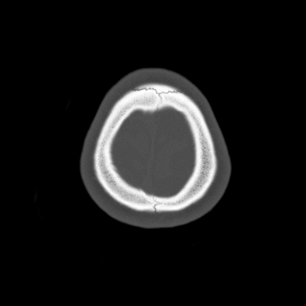 Calvarial osteoma (Radiopaedia 36520-38079 Axial bone window 101).jpg