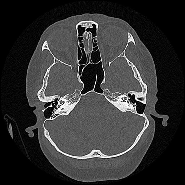 Canal up mastoidectomy (Radiopaedia 78108-90638 Axial bone window 71).jpg