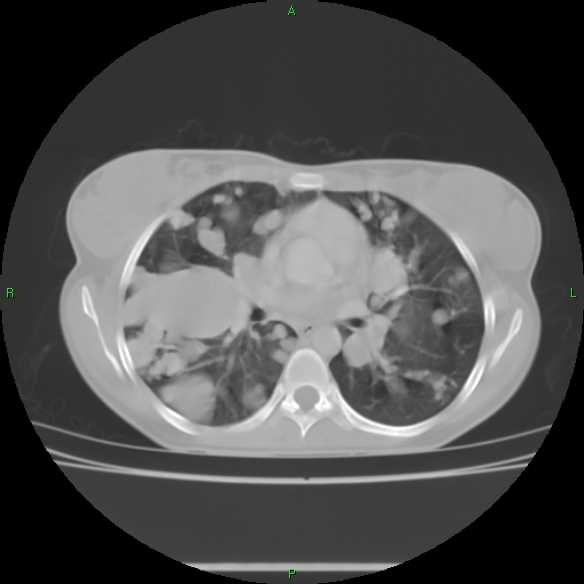 File:Cannon ball metastases - synovial sarcoma (Radiopaedia 26135-26271 Axial lung window 18).jpg