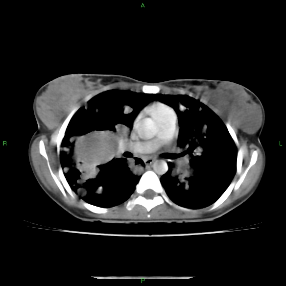 File:Cannon ball metastases - synovial sarcoma (Radiopaedia 26135-26271 C 17).jpg