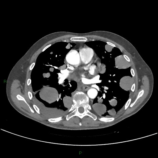 Cannonball metastases (Radiopaedia 82110-96150 Axial C+ CTPA 172).jpg