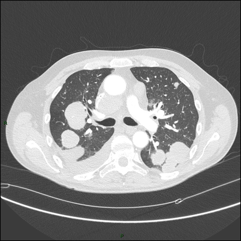 Cannonball metastases (Radiopaedia 82110-96150 Axial lung window 85).jpg