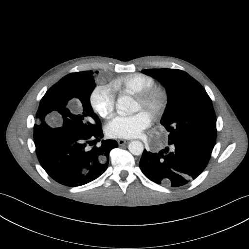 Cannonball metastases - testicular choriocarcinoma (Radiopaedia 84510-99891 B 67).jpg