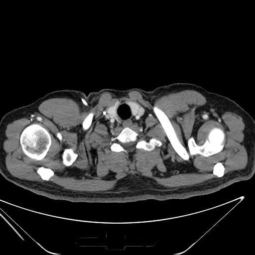 File:Cannonball pulmonary metastases (Radiopaedia 67684-77101 D 2).jpg