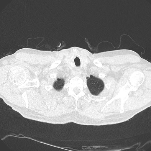 Caplan syndrome (Radiopaedia 56667-63530 Axial lung window 19).jpg