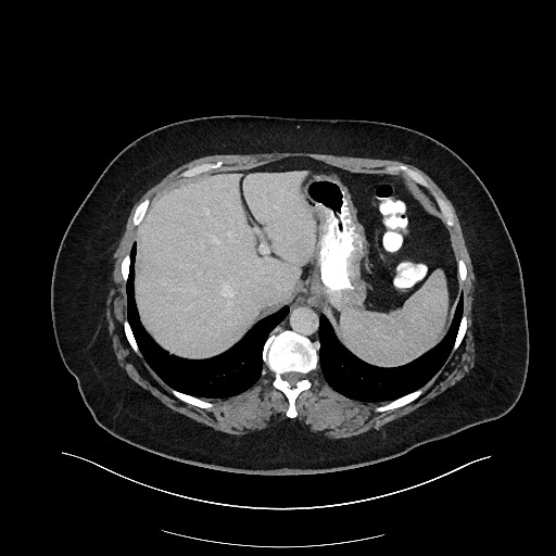 Carcinoid tumor - terminal ileum (Radiopaedia 60931-68739 A 25).jpg
