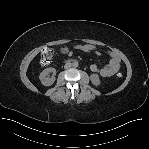 Carcinoid tumor - terminal ileum (Radiopaedia 60931-68740 Axial non-contrast 56).jpg