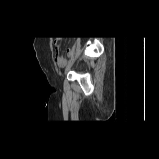 File:Carcinoma cervix- brachytherapy applicator (Radiopaedia 33135-34173 D 32).jpg