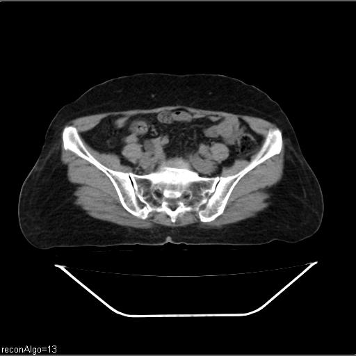 File:Carcinoma cervix- recurrence (Radiopaedia 34702-36137 Axial non-contrast 38).jpg