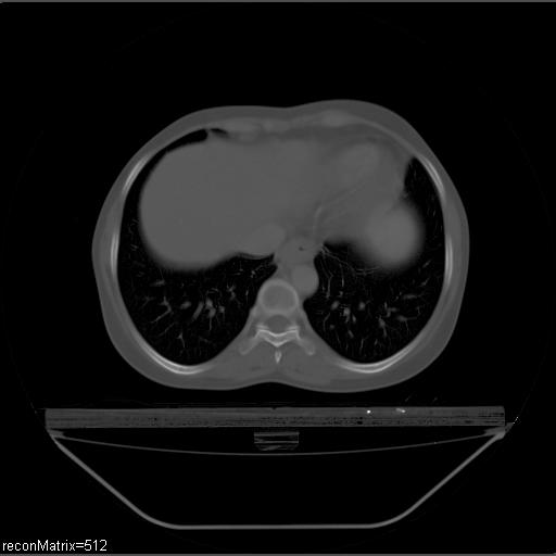File:Carcinoma of esophagus (Radiopaedia 27356-27550 Axial bone window 10).jpg
