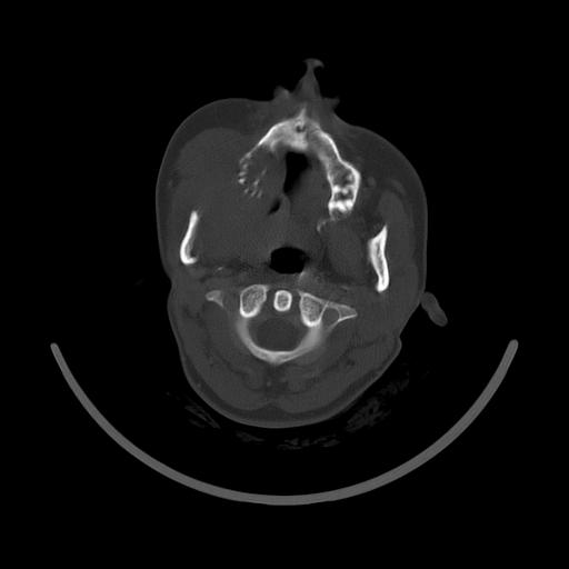 Carcinoma of the maxillary antrum (Radiopaedia 53805-59888 Axial bone window 69).jpg
