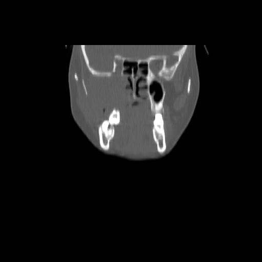 Carcinoma of the maxillary antrum (Radiopaedia 53805-59888 Coronal bone window 49).jpg