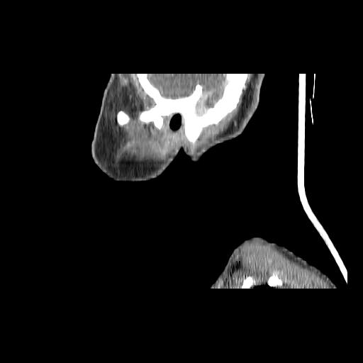 Carcinoma of the maxillary antrum (Radiopaedia 53805-59888 Sagittal C+ delayed 28).jpg
