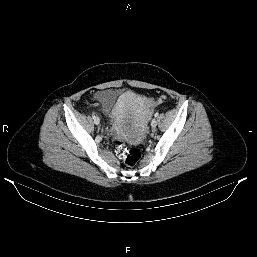 Carcinoma of uterine cervix (Radiopaedia 85861-101700 A 67).jpg