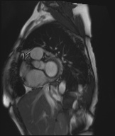 Cardiac amyloidosis (Radiopaedia 51404-57150 Sagittal CINE SSFP 266).jpg