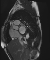 Cardiac amyloidosis (Radiopaedia 51404-57150 Sagittal CINE SSFP 289).jpg