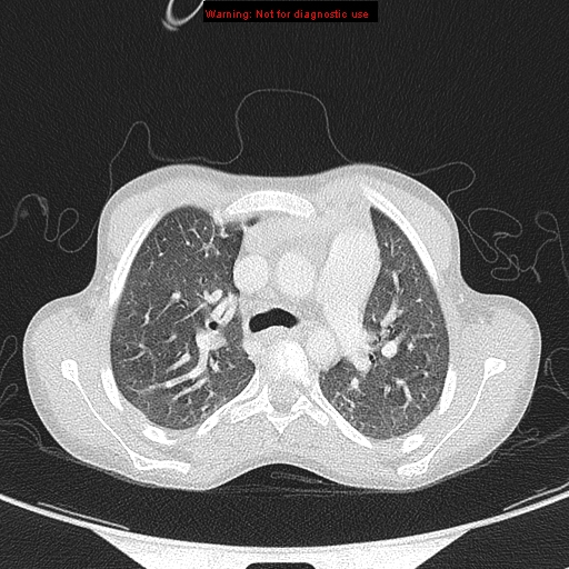 File:Cardiac bronchus (Radiopaedia 14059-13899 A 5).jpg