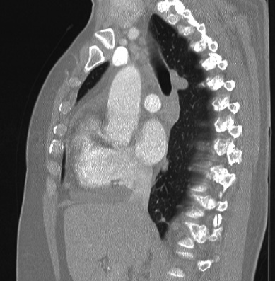 File:Cardiac sarcoidosis (Radiopaedia 74548-85534 Sagittal lung window 51).jpg