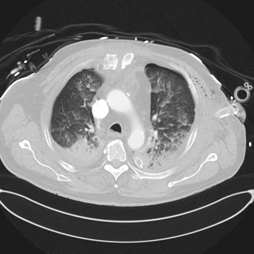 File:Cardiac trauma (Radiopaedia 32874-33858 Axial lung window 18).jpg