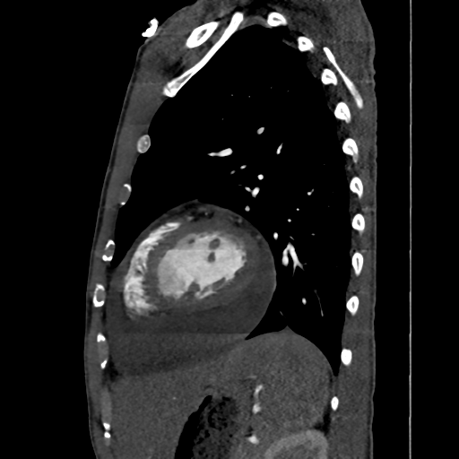 Cardiac tumor - undifferentiated pleomorphic sarcoma (Radiopaedia 45844-50134 B 19).png