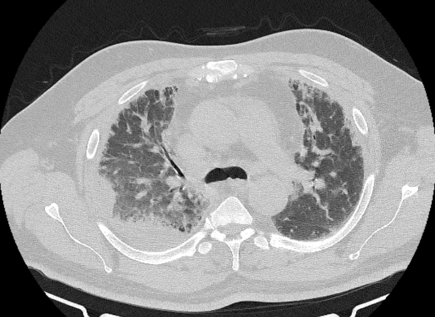 Cardiogenic pulmonary edema (Radiopaedia 68180-77678 Axial lung window 30).jpg