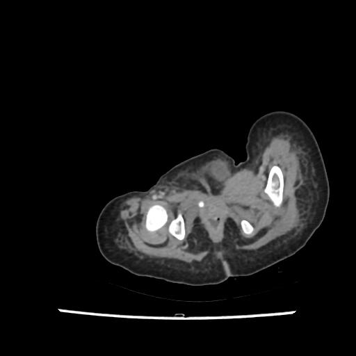 File:Caroli disease with autosomal recessive polycystic kidney disease (ARPKD) (Radiopaedia 89651-106703 B 236).jpg