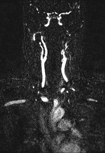 Carotid artery dissection (Radiopaedia 28441-28689 Coronal MRA 35).jpg