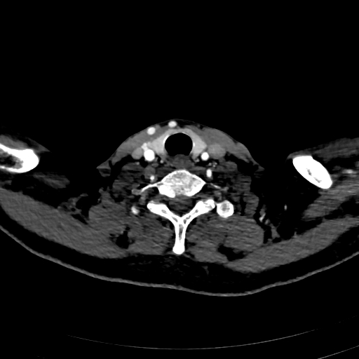 File:Carotid body tumor (Radiopaedia 83615-98727 A 94).jpg
