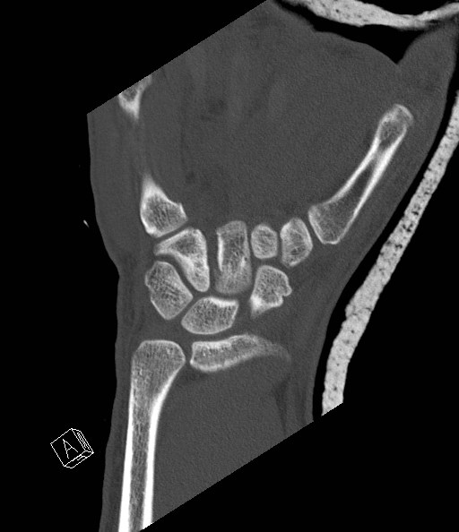 File:Carpal fractures (smart watch impaction) (Radiopaedia 55844-62430 Coronal bone window 15).jpg