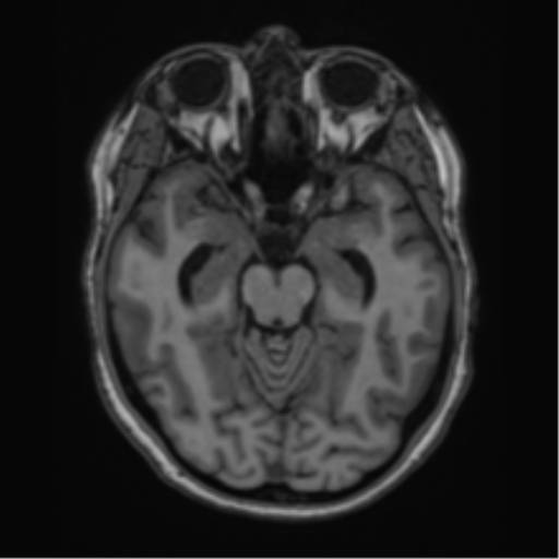 Cavernoma with bleed - midbrain (Radiopaedia 54546-60774 Axial T1 12).png