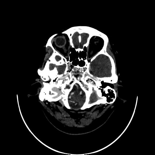 Cavernoma with developmental venous anomaly (Radiopaedia 22470-22506 C 13).jpg