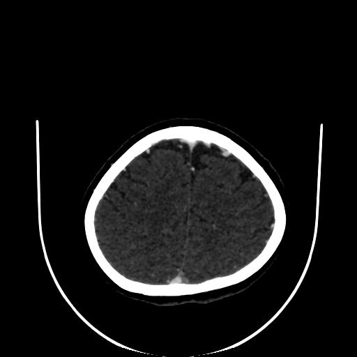 Cavernoma with developmental venous anomaly (Radiopaedia 22470-22506 C 160).jpg