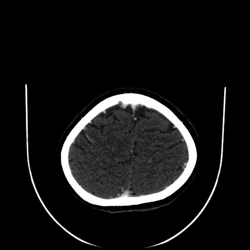 Cavernoma with developmental venous anomaly (Radiopaedia 22470-22506 C 167).jpg