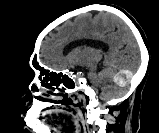 Cavernous hemangioma of the cerebellar falx (Radiopaedia 73025-83723 B 191).jpg