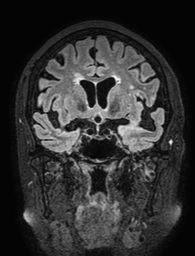 Cavernous hemangioma of the cerebellar falx (Radiopaedia 73025-83724 Coronal FLAIR 136).jpg