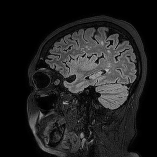 Cavernous hemangioma of the cerebellar falx (Radiopaedia 73025-83724 Sagittal FLAIR 48).jpg