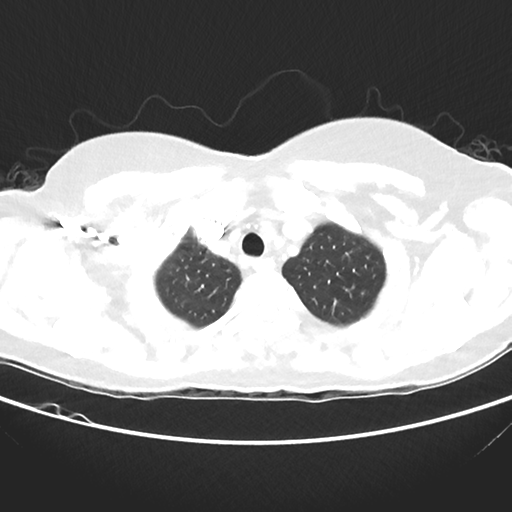 File:Cavitating lung mass - squamous cell carcinoma (Radiopaedia 48047-52854 Axial lung window 8).png