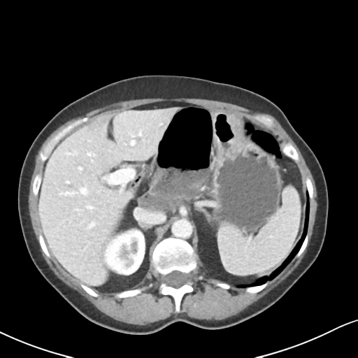 Cecal internal hernia through the foramen of Winslow (Radiopaedia 44820-48651 B 20).png