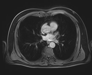 Cecal mass causing appendicitis (Radiopaedia 59207-66532 T1 C+ PV phase 3).jpg