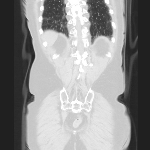 Cecal volvulus (Radiopaedia 75378-86620 Coronal lung window 114).jpg