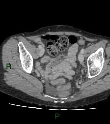 Cecal volvulus (Radiopaedia 86741-102900 A 114).jpg
