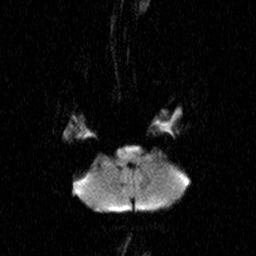 File:Central-variant posterior reversible encephalopathy syndrome (PRES) (Radiopaedia 43880-47358 Axial DWI 4).jpg