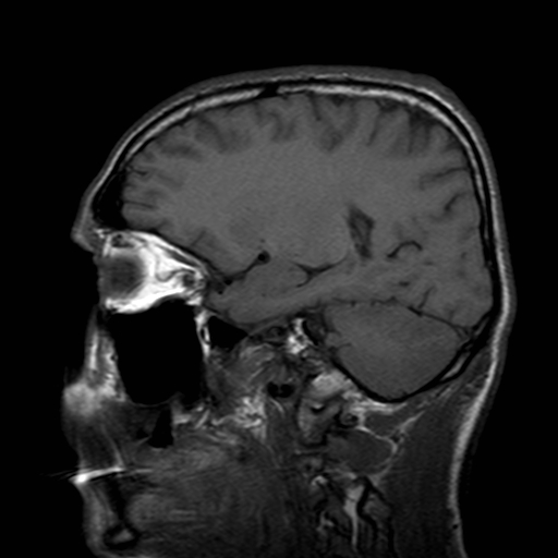 File:Central-variant posterior reversible encephalopathy syndrome (PRES) (Radiopaedia 43880-47358 Sagittal T1 16).jpg