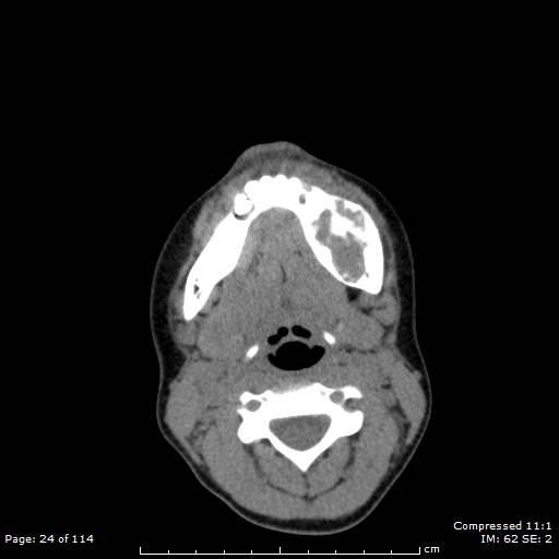Central giant cell granuloma (Radiopaedia 45612-49754 Axial non-contrast 12).jpg