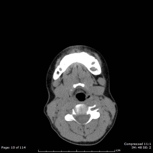 File:Central giant cell granuloma (Radiopaedia 45612-49754 Axial non-contrast 5).jpg