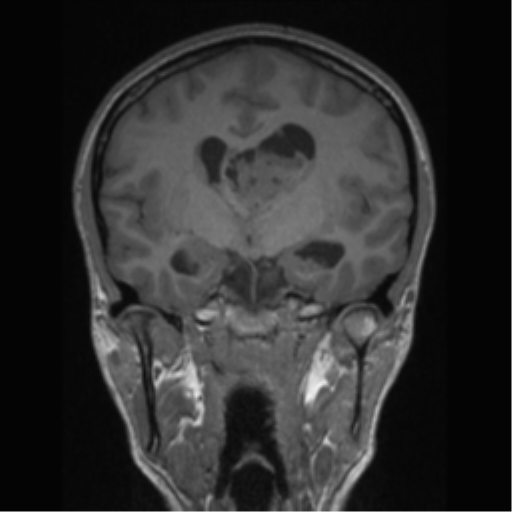 Central neurocytoma (Radiopaedia 37664-39557 Coronal T1 48).png