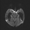 Central neurocytoma (Radiopaedia 56690-63469 Axial DWI 44).jpg